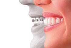 Invisalign Profile